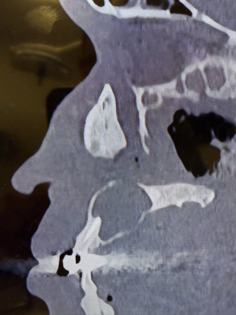 JohnCraigNose's tweet photo. Well this should provide plenty of goals to achieve in one surgery. Should be very cool healed postop images! #ODS #odontogeniccyst #recalcitrantCRS #MEMM #DrafIII 😎 @henryfordent @Rayan_alfallaj @MakaryENT https://t.co/vSzprxDVLc