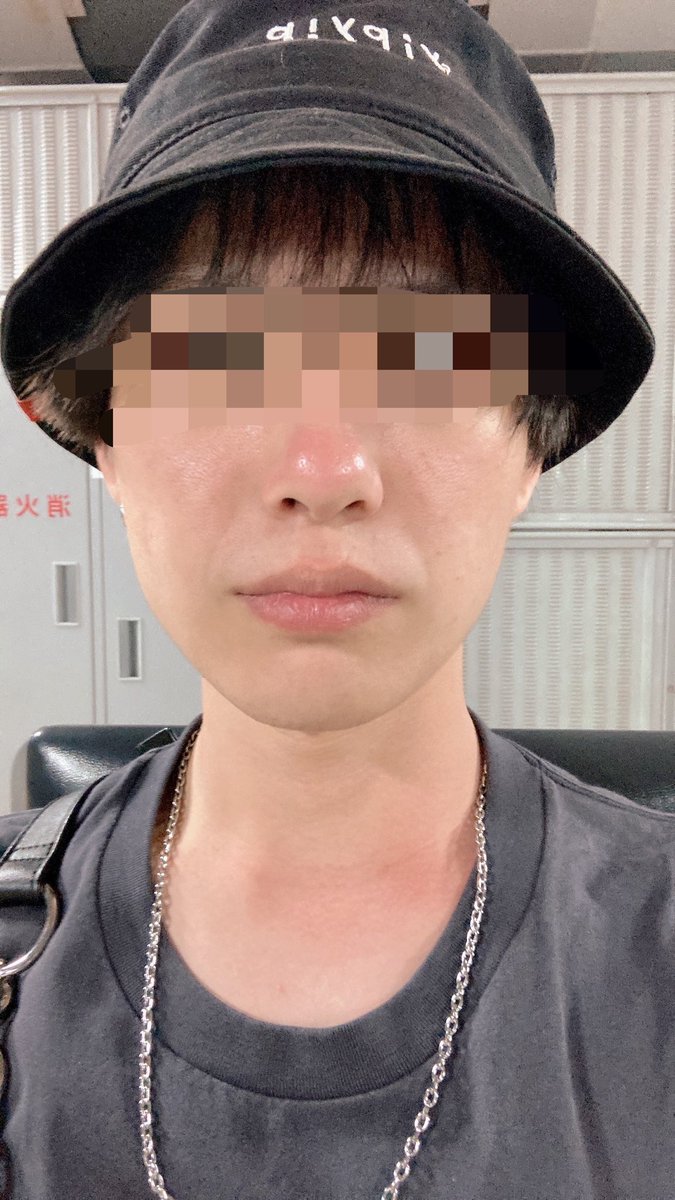 frontale__ryo's tweet photo. 日焼け止め塗らんと屋外でのイベントではこんなに赤くなります。皆さんお気をつけて。久しぶりにこんな焼けたわ https://t.co/wtasKf1gRl