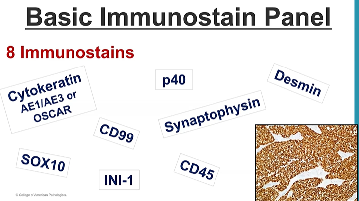 Janiranavarro's tweet photo. For sinonasal blue tumors, use a panel approach for immunohistochemistry

Basic immunostain panel:
- CK (AE1/AE3 or OSCAR)
- p40
- SOX10
- CD99
- Desmin
- Synaptophysin
- INI-1
- CD45

Dr. Lewis #JobPrepBootcamp #NIPCAP #pathology #PathX https://t.co/Rd64CENMsX