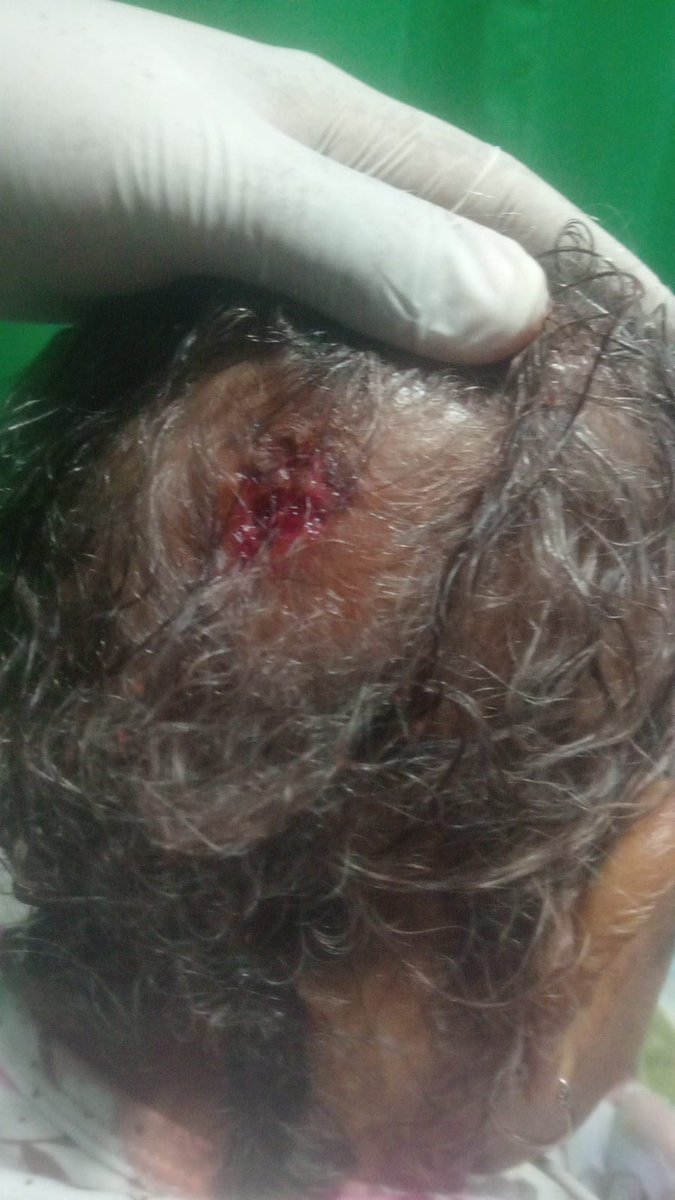 RLopezcoba's tweet photo. ¡INDIGNANTE!
Anoche, aproximadamente a las 8:05 p.m., un adulto mayor de 97 años de edad, portador de colostomía, ingresó al Hospital Universitario del Norte, sede Ceres en Soledad, después de sufrir una caída que le ocasionó un fuerte golpe en la cabeza y sangrado persistente. https://t.co/5Pp4AoQdjU
