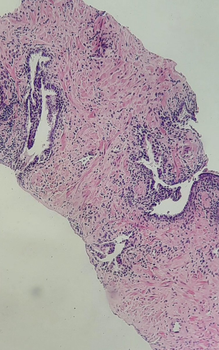 samirapath's tweet photo. Prostate biopsy  70ys PSA 13. https://t.co/LRGphOGfQH