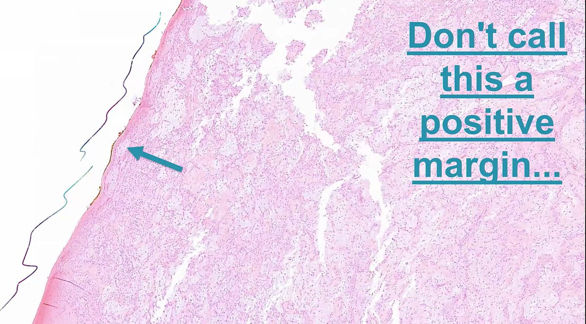 Janiranavarro's tweet photo. Pleomorphic adenoma
***Practical issues***

The parotid gland is rich in facial nerve branches, so the surgeon must carefully peel the tumor away from them

✅ If the inked margin is smooth and undulated, this is not a positive margin (see Pic 1)
Sign out the case as in Pic 2

❌ If the margin appears chewed up or irregular, this is a positive margin (see Pic 3).
Sign out the case as in Pic 4.

Dr. Lewis #JobPrepBootcamp #NIPCAP #pathology #PathX #pathtwitter