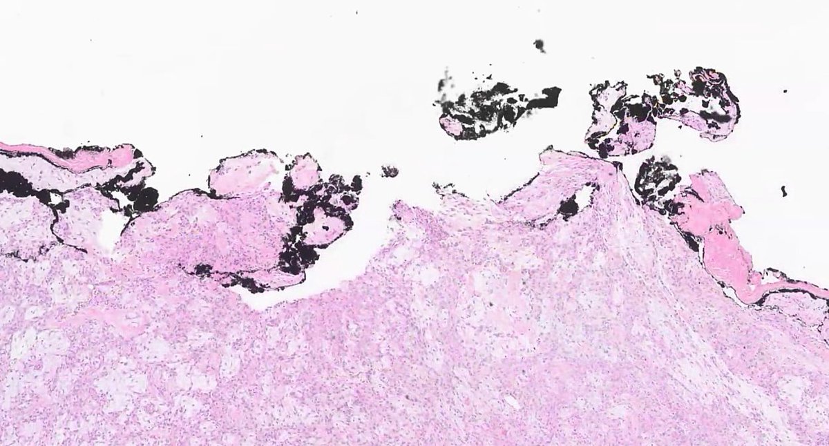 Janiranavarro's tweet photo. Pleomorphic adenoma
***Practical issues***

The parotid gland is rich in facial nerve branches, so the surgeon must carefully peel the tumor away from them

✅ If the inked margin is smooth and undulated, this is not a positive margin (see Pic 1)
Sign out the case as in Pic 2

❌ If the margin appears chewed up or irregular, this is a positive margin (see Pic 3).
Sign out the case as in Pic 4.

Dr. Lewis #JobPrepBootcamp #NIPCAP #pathology #PathX #pathtwitter