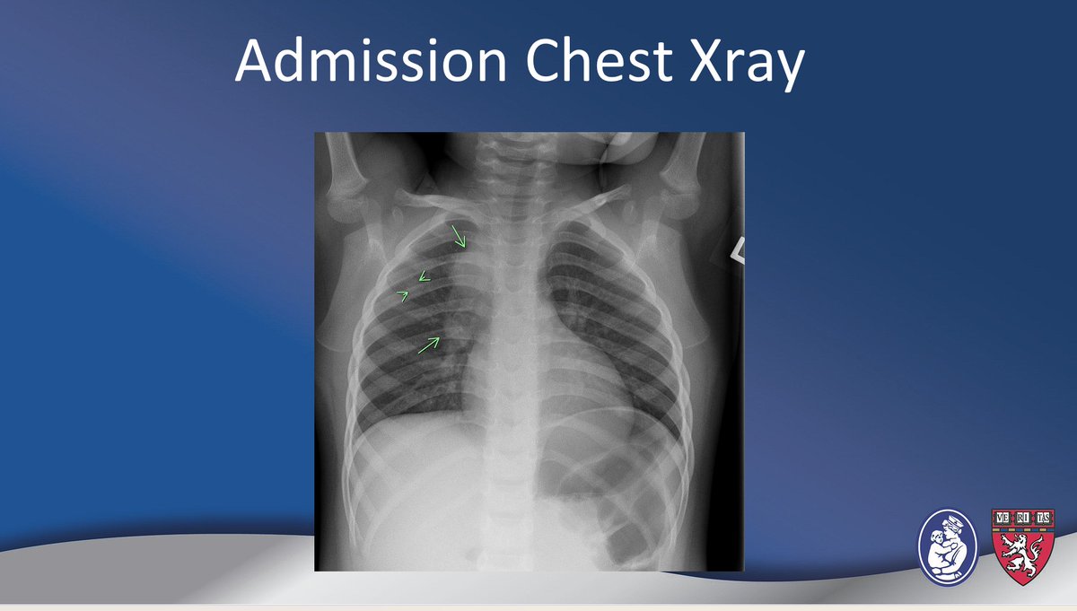 The_ASPNR's tweet photo. 🧠 A fascinating case by Dr. Tina Young Poussaint. What imaging clues can help distinguish infection such as tuberculosis in this case from neoplasm when the appearances are strikingly similar? A great example of why clinic radiologic correlation remains essential.
🔍 Key takeaway: Keep a broad differential diagnosis when evaluating leptomeningeal disease, and always correlate imaging, clinical findings, and pathology.
#pedineurorad #IPNTN #PedRad #ASPNR @TYPoussaintMD @MirskyDavid @RLClarkeMD @laura1127md @drmankad @ArzuOztrkMD @alexandra_foust @HarumyYoshikawa @JamieClarkeRad