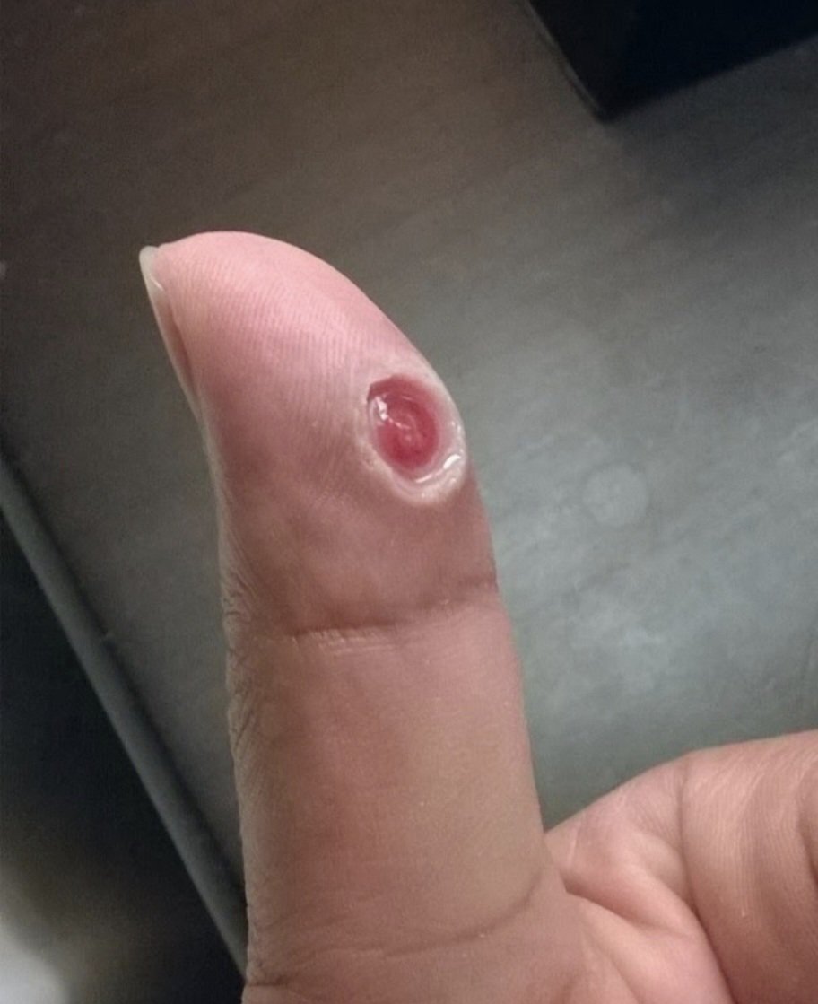 alexkmunoz's tweet photo. @Mrymyildiz Yo tuve años atrás algo parecido ( nombre de que fue no recuerdo)...se hacía una  costra en exceso y nunca sanaba y me tuvieron que operar sacando todo el  exceso. Obvio despues sanó sin problemas. Fui a un dermatolgo. https://t.co/sAKfJACxJ3