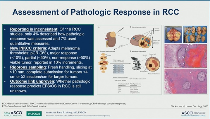 nataliagandur's tweet photo. #ASCO26 GU Oncology Spotlight 🚨

🔬 Neoadjuvant Treatment Strategies in Renal Cell Carcinoma
Presented by Rana R. McKay, MD, FASCO
@DrRanaMcKay
@OncoAlert
@ASCO
Neoadjuvant therapy in RCC remains one of the most important open questions in GU oncology.

The rationale is compelling:
➡️ treat micrometastatic disease earlier
➡️ assess treatment sensitivity in vivo
➡️ potentially downstage tumors
➡️ inform surgical timing
➡️ improve long-term outcomes

But the field is still not ready for routine practice.

Why?

Because activity is not the same as validated clinical benefit.
Modern IO-based regimens can shrink primary kidney lesions in metastatic RCC:
• CheckMate 214: kidney lesion ≥30% decline in 35%
• CheckMate 9ER: ≥30% decline in 51%
• CLEAR: median kidney lesion shrinkage 46%
Pathologic activity has also been reported after IO before nephrectomy:
• 52 patients across 9 sites
• 44% pathologic downgrading
• 13% pCR

These signals are biologically important.

But they do not yet define a standard neoadjuvant approach.

📌 Timing may matter.

In melanoma, trials such as SWOG-S1801 and NADINA support the superiority of neoadjuvant IO over adjuvant-only strategies.

That concept is highly provocative for RCC.
Could immune activation be more effective when the primary tumor is still present?
Maybe — but RCC-specific evidence remains incomplete.

🧪 Current neoadjuvant/perioperative RCC data remain limited.

Several early studies have explored:
• nivolumab
• avelumab + axitinib
• sitravatinib + nivolumab
• nivolumab-based combinations
Most are small phase II or single-arm studies.

And the largest randomized perioperative RCC trial, PROSPER, did not improve EFS:

➡️ nivolumab vs observation
➡️ EFS HR 0.94
➡️ 95% CI 0.74–1.21

So enthusiasm must remain evidence-based.

🧬 The endpoint problem is critical.

If neoadjuvant RCC is going to move forward, we need standardized pathologic response criteria.

Central principles:

✓ standardized
✓ reproducible
✓ correlated with outcomes

The INMC pathologic response framework categorizes viable tumor in the treated bed as:

• pCR: 0%
• near pCR: ≤10%
• pPR: >10–50%
• pNR: >50%

But reporting has been inconsistent.
In one review of RCC studies:
• only 4% described how pathologic response was assessed
• only 7% used quantitative measures
That is a major limitation.

Unlike some other tumors, we still do not fully know whether pathologic response reliably predicts EFS or OS in RCC.

🚧 New trials are trying to answer the right questions.

NEOSHIFT is testing pembrolizumab + belzutifan before radical nephrectomy in selected clear-cell RCC.
The LUNAR platform is designed to evaluate multiple neoadjuvant strategies in RCC, including systemic therapy followed by nephrectomy and adjuvant therapy.
These platform-style approaches are exactly what the field needs.

💬 My take:

Neoadjuvant RCC is promising — but still investigational.

Combination strategies have generated pathologic response signals.

But before changing practice, we need:

✓ validated RCC-specific pathologic endpoints
✓ biomarkers of response
✓ clarity on surgical safety
✓ correlation with long-term outcomes
✓ randomized evidence
✓ patient selection
The goal is not simply to shrink the kidney tumor.
The goal is to prove that earlier systemic therapy improves meaningful outcomes.

For now, neoadjuvant RCC belongs in clinical trials whenever possible.
@DrChoueiri 🇺🇸@hoperugo 🇺🇸 @matteolambe 🇮🇹 @TiansterZhang 🇺🇸 @CathyEngMD 🇺🇸 @stolaney1 🇺🇸 @montypal 🇺🇸 @tompowles1 🇬🇧 @brian_rini 🇺🇸 @cdanicas 🇪🇸 @NiuSanford 🇺🇸 @amerseburger 🇩🇪 @GlopesMd 🇺🇸 @Icro_Meattini 🇮🇹 @PGrivasMDPhD 🇺🇸 @DrYukselUrun 🇹🇷
#ASCO26 #GUOnc #KidneyCancer #RCC #NeoadjuvantTherapy #Immunotherapy #PrecisionOncology #ClinicalTrials
