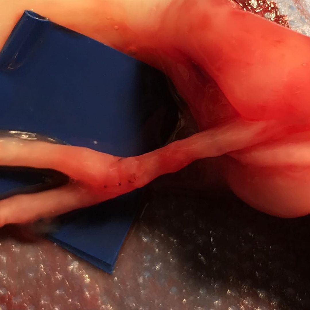 remevet's tweet photo. Microanastomosis lateroterminal 🔬
Arteria de 1.2mm🔍
Se realiza con poliamida 11-0 🤯

La #microcirugía es una especialidad quirúrgica con una curva de aprendizaje más lenta en comparación con la cirugía convencional.

MV Esp. MSc. Felipe Graciano. https://t.co/RDpDnwQPwt