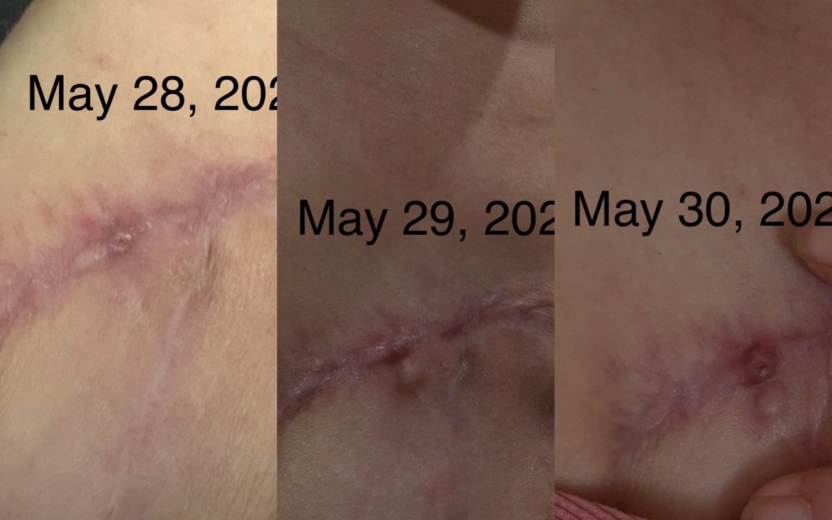 theklineventure's tweet photo. I likely have a 4th reoccurrence of triple negative Metaplastic breast cancer. Fine needle biopsy Monday. 

I don’t usually ask for help but I’m running out of treatment options. If you could like, comment, share, tag anyone who is going through Metaplastic or has beat it I would be so grateful 🥲🫶🏼 

Hoping someone who’s gotten to remission from Metaplastic can help guide me on next steps 🙏🏼🙏🏼