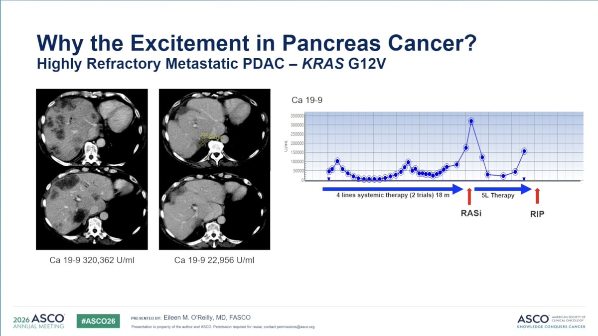 OncLive's tweet photo. @EileenMOReilly of @MSKCancerCenter with an excellent overview of #KRAS targeting in #PancreasCancer at #ASCO26. A truly remarkable time with multiple strategies targeting RAS, opening new frontiers in  treatment and thought about modulating the tumor microenvironment and potentials for combination strategies.

@Jonathanwlee23  @CentralParkWMD  @drallysonocean  @NBalmacedaMD 

#MedEd
#Oncology