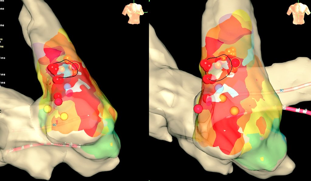 nelsonpol's tweet photo. 👩🏼 58 años con CVP muy frecuentes, con palpitaciones.
🔸Ecg: origen en TSVD pared libre postero-lateral. 
🔸Mapeo: HD Grid todo el trayecto hasta tener referencia anatómica de auricula derecha, venas cavas, y TSVD.
🔸Precocidad: 40mseg
🔸Pacemapping: 11/12 (98%)

#Zerofluoro https://t.co/P7HWcO1MmN