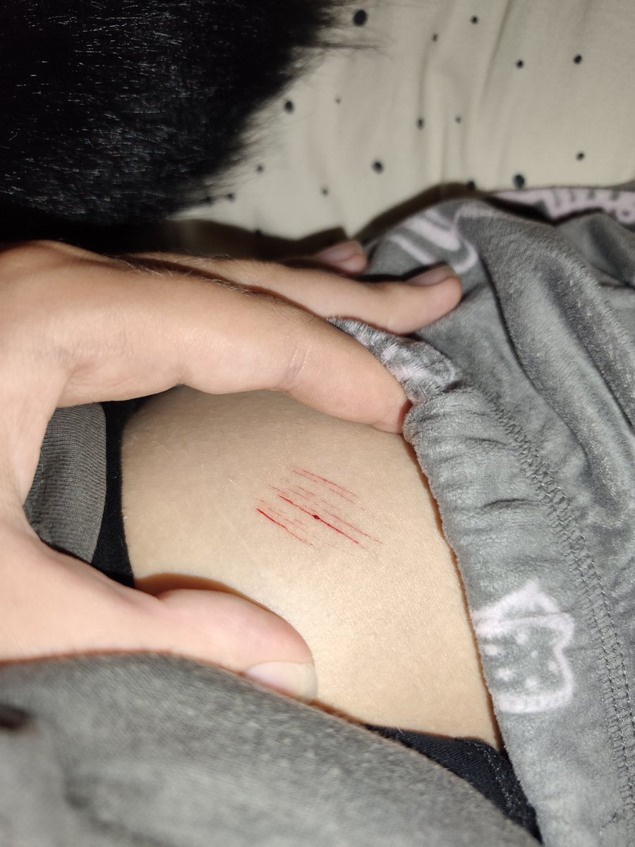 Call_Me_Mon_Roi's tweet photo. Some small cuts because I can't allow myself to do more or my mom will notice (also did some on my chest but won't show for obvious reasons...) https://t.co/qdIXJyt6bp