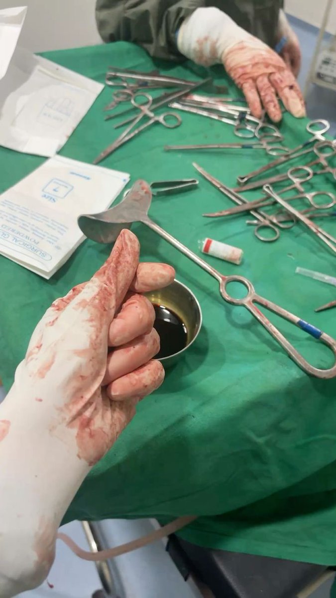 ItsMrHealth's tweet photo. One of the common medical reasons a mother may deliver by caesarean section is CPD (Cephalopelvic Disproportion)...

CPD happens when the baby’s head is too large, or the mother’s pelvic opening is too small, making it difficult for the baby to pass through the birth canal safely during normal delivery...

In simple terms...

The baby and the mother’s pelvis are not a good fit for vaginal delivery...

Because of this risk, doctors often recommend a C-section to ensure the safety of both mother and baby.....