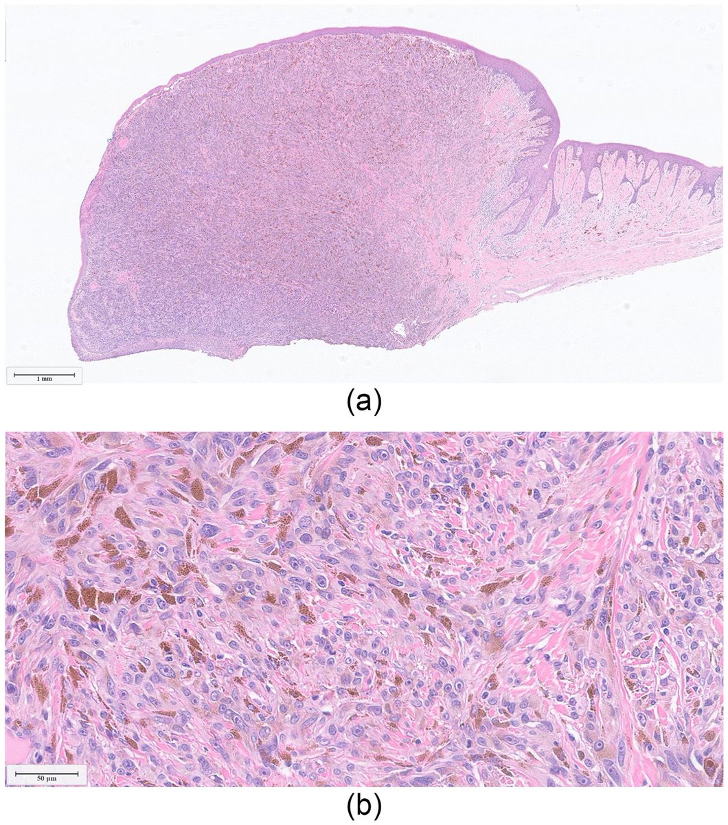 IJSPjournal's tweet photo. 🚨Neuroendocrine marker expression in mucosal melanomas of the H&amp;N might represent an important diagnostic pitfall!
Shah et al. in IJSP (link: https://t.co/jEOcoWxX5u) show how synaptophysin alone might not be the best screening marker in the dx work-up.
#PathTwitter #ENTPath https://t.co/a7QSwztMC9