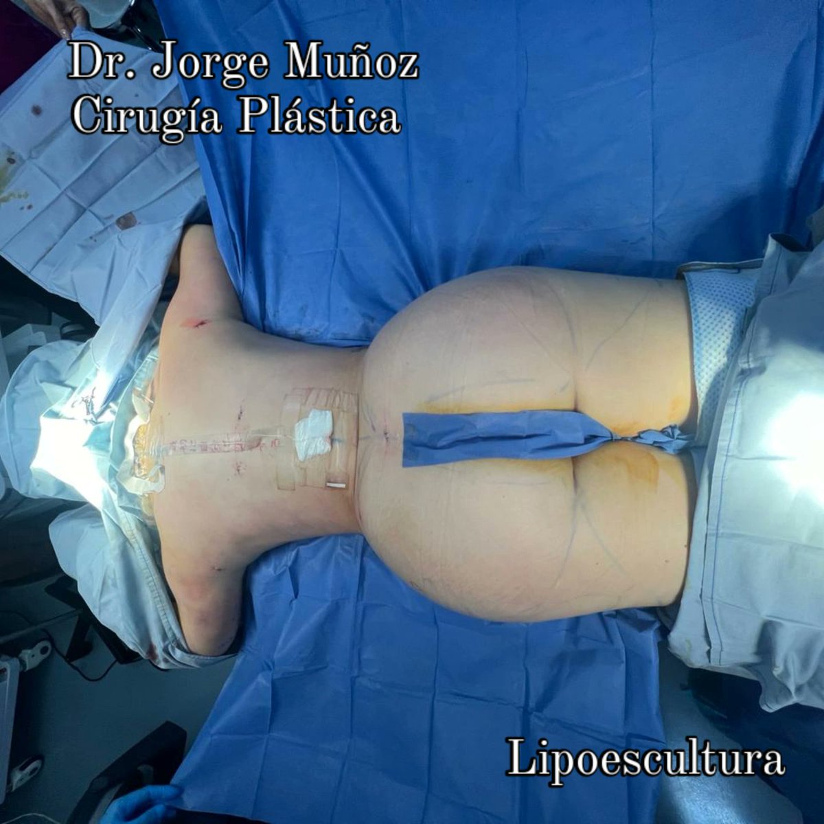 jm_surgery's tweet photo. Dr. Jorge Muñoz
Cirugía Plástica, Estética y Reconstructiva
https://t.co/f4BF9MQFGm
Cédula Profesional 5797888
Cédula Especialidad 11306241
Cédula Estatal 1915716ES III
Certificación Consejo (CONACEM) 2073
Aviso de Publicidad COFEPRIS 2308012002A00004

#bbl #lipo #ribxcar https://t.co/EWb2qJUB3M