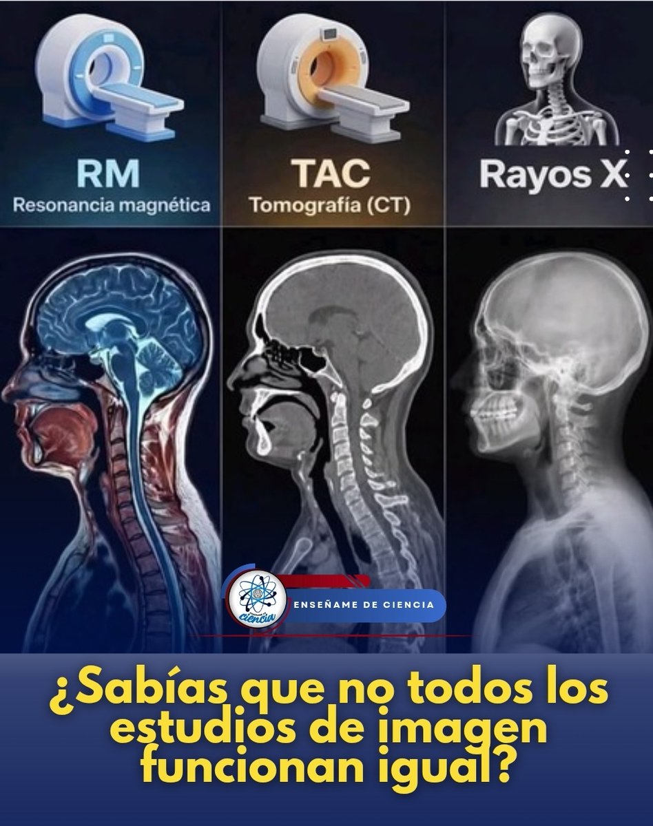 EnsedeCiencia's tweet photo. Los rayos X son ideales para observar huesos y detectar fracturas rápidamente. La TAC (Tomografía Axial Computarizada) ofrece imágenes más detalladas de órganos, tejidos y estructuras internas. Por su parte, la Resonancia Magnética (RM) utiliza campos magnéticos para obtener imágenes muy precisas, especialmente de músculos, ligamentos, cerebro y médula espinal.

Cada estudio tiene una función específica y ayuda a los médicos a realizar diagnósticos más precisos