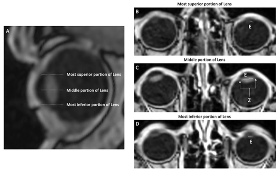 Advances_ASTRO's tweet photo. What side effects are associated with ☢️ to the lens 👁️?  

This critical review discusses ☢️-induced cataractogenesis, including: 
🔘 Physiology and anatomy of the lens 👁️
🔘 Risk factors (dose, fractionation, age) and timing of ☢️ cataractogenesis
🔘 Assessment tools and types of cataracts 
🔘 Step-by-step contouring guide of the lens 👁️

🔗- https://t.co/SZI5ouL3sp

@ASTRO_org #radonc