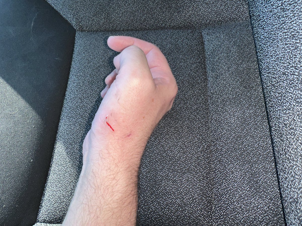 roadresident's tweet photo. Ouch! I accidentally slammed my hand in my van door today. 

Anyone else ever accidentally do  that too? 😖 https://t.co/7fAYiraCdi