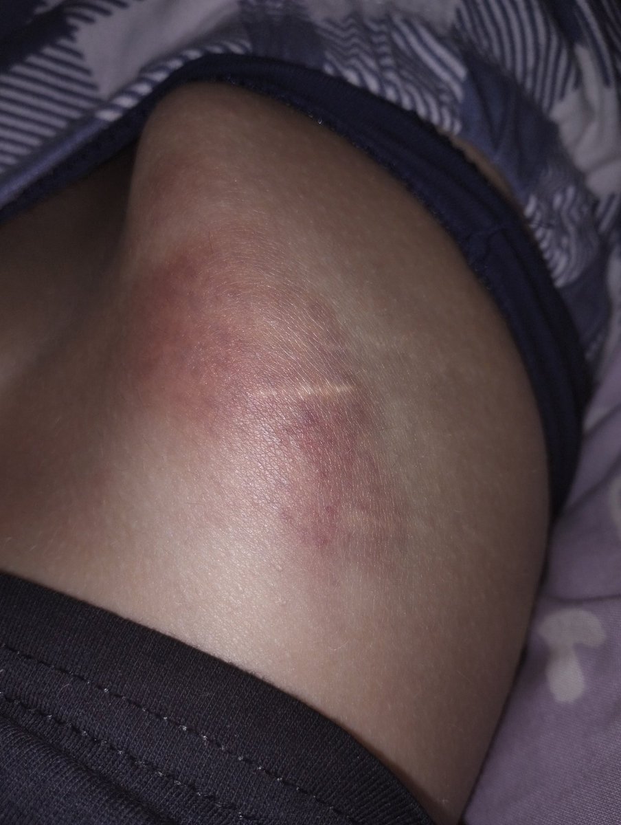 bboywithpaws's tweet photo. hip #shedtwt #bruisestwt #bruisetwt https://t.co/wrKiI8mAe4