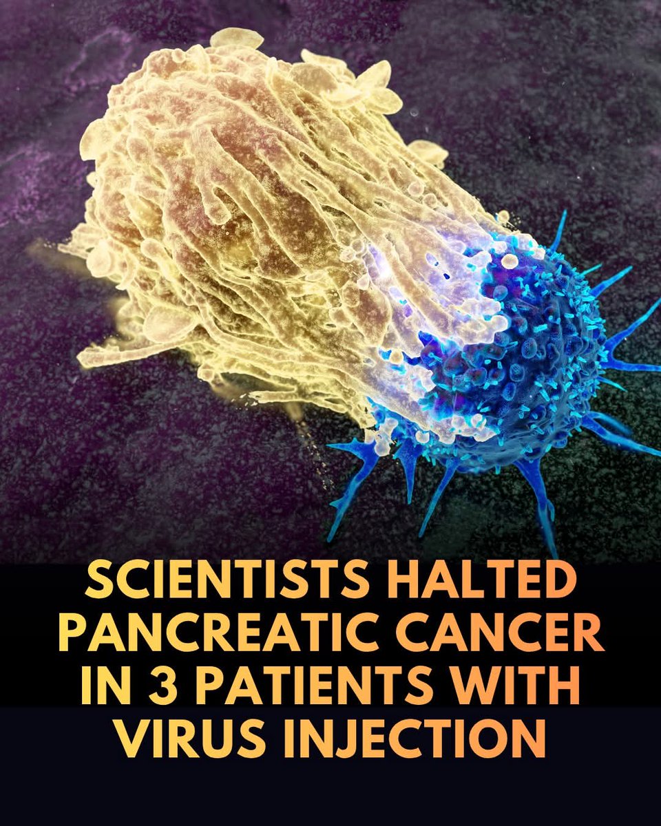 SmartScience's tweet photo. A virus that kills cancer has stopped pancreatic tumors in three people.

Currently, the 5 year survival rate for pancreatic cancer is just 13%. This could change everything. 

An experimental, cancer-killing virus has halted advanced pancreatic tumors in three clinical trial patients, despite researchers administering just one-tenth of the targeted therapeutic dose.

In an unexpected medical breakthrough, an early-stage clinical trial designed solely to evaluate the safety of an experimental oncolytic virus ended up halting the growth and spread of advanced pancreatic tumors in three patients. Led by Dr. Masato Yamamoto at the University of Minnesota, the trial administered just one-tenth of the targeted, eventual dose. Despite this microscopic amount, the modified virus successfully targeted the patients' tumors, raising hopes for a powerful new weapon against one of the deadliest forms of cancer.

The treatment works by utilizing a genetically modified virus that selectively infiltrates and multiplies inside cancer cells, causing them to burst while sparing healthy surrounding tissues. While these early-stage results are incredibly encouraging, experts urge caution, noting that the trial was extremely small and that larger-scale, multi-phase clinical evaluations are still required to confirm how reliably the treatment works in a broader population.

source: New Scientist. (2026, May 29). Pancreatic cancer halted by virus injection in three patients.