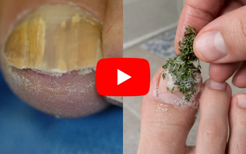besttoffer's tweet photo. 🧦 This "Sock Trick" May Help With Stubborn Nail Concerns

Most nail products only work on the surface.

But many nail concerns start underneath.

Where creams and polishes struggle to reach.

A simple "sock trick" is getting attention online.

It was designed to help active ingredients stay in contact with the nail area longer.

Many users report healthier-looking nails within weeks.
👇
https://t.co/6JgztMuYq8?