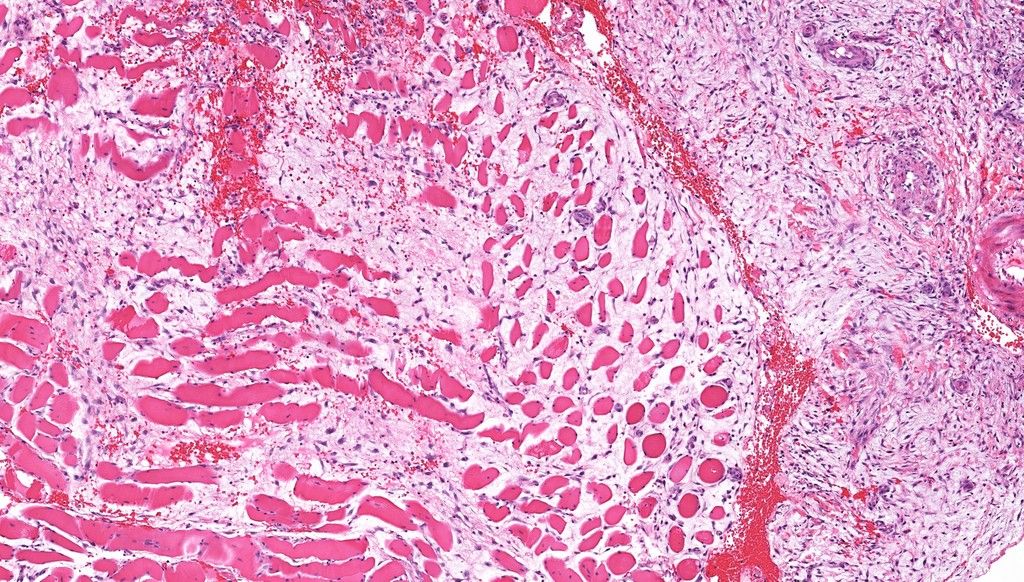 JMGardnerMD's tweet photo. 25 yo F with intramuscular arm mass.
Digital slide: https://t.co/voOhnYULlR
Radiology: https://t.co/vNwz24Qx2E
Answer ✅ https://t.co/aDwp5kZAUT
#BSTpath #pathologists #pathology #pathTwitter #radpathmatch https://t.co/kcOmZMgTh5