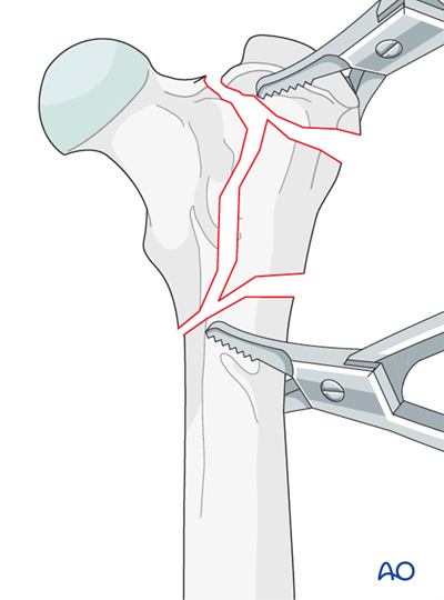 AOSurgery's tweet photo. Ready to deepen your knowledge of Dog proximal femur treatments?🐕

Explore the comprehensive AO Surgery Reference module on dog proximal femur for in-depth guidance, complete with detailed illustrations and case examples. 

➡️ https://t.co/SQnuj2KCKV

#AOVET #AOSurgeryReference https://t.co/xnWSueffrk