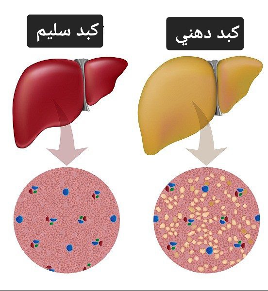arabaltmed's tweet photo. الكبد ينظف نفسه 
جميل جدا 
ولكن ساعده في التخلص من الدهون اللي تعيق هذا التنظيف 
✔️الاكل يكون بعد ان تستيقظ ب ٣ ساعات واخر وجبه خفيفه قبل ان تنام ب ٣ ساعات
✔️اشرب الخل التفاح الطبيعي ملعقه صغيره مع كوب ماء بشكل يومي 
✔️اترك النقرشه بين الوجبات 
✔️اي اكل او شراب مصنع  اتركه
✔️البيض البلدي يسمح وتجنب بيض المزارع 
✔️اترك القمح والسكر والمنبهات كلها بما فيها القهوة والنسكافيه 
✔️اعمل الحجامه بشكل دوري
✔️الصيام المتقطع ضروري
✔️مره كل شهر أو ٢ او ٣ اعمل تنظيف للامعاء بشربه سنامكي
✅️تذكر 
ان الكبد الدهني تكون في اشهر عديده 
والشفاء منها يحتاج للصبر وأشهر من التزام الأكل الصحي 
قم بعمل فحوصات مخبريه بشكل دوري حتى تطمن انك تعمل الصح 
نسال الله لكم الشفاء العاجل والسلامه يا رب