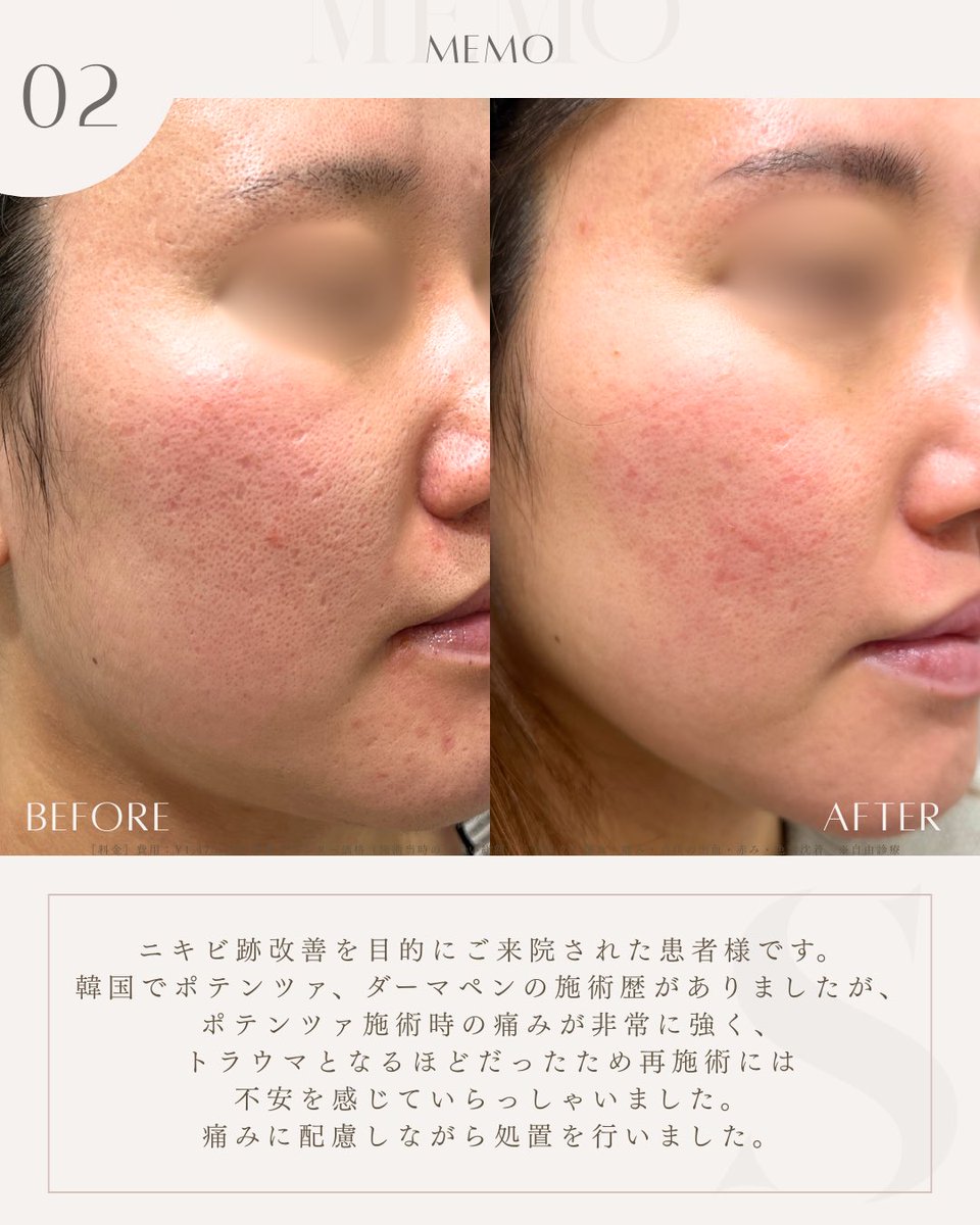 SELECTCLINIC's tweet photo. 【　フェイスラインのもたつきに🪞✨　】

〈 症例紹介 〉

フェイスラインのたるみ・もたつきが気になる方へ。

高周波RF治療「アッティバ」で
フェイスラインへアプローチした症例です💭

1回の施術でも、
フェイスラインが引き締まり、
輪郭がすっきりとした印象へ🫧

切開や糸を使わず、
自然なリフトアップを目指したい方にもおすすめの治療です✨

〈 施術内容 〉
・アッティバ（フェイスライン）1回

〈 患者様情報 〉
年代：40代後半女性
お悩み：たるみ・もたつき

セレクトクリニックでは、
一時的な変化ではなく、
“肌質そのものを整えること”を大切にしています🫧

美容医療が初めての方や、
治療に不安を感じている方にも
安心してお越しいただけるよう、
丁寧なカウンセリングを心がけています💭🌟

お肌状態をしっかりと診察した上で、
今のお悩みやライフスタイルに合わせた
治療内容・必要回数をご提案いたします☺️🎀

「どの施術が合うかわからない」
「まずは相談だけしてみたい」

そんな方も大歓迎です🕊️✨

カウンセリングのみのご来院も可能ですので、
どうぞお気軽にご相談くださいませ
