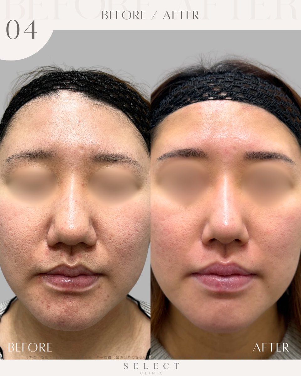 SELECTCLINIC's tweet photo. 【　フェイスラインのもたつきに🪞✨　】

〈 症例紹介 〉

フェイスラインのたるみ・もたつきが気になる方へ。

高周波RF治療「アッティバ」で
フェイスラインへアプローチした症例です💭

1回の施術でも、
フェイスラインが引き締まり、
輪郭がすっきりとした印象へ🫧

切開や糸を使わず、
自然なリフトアップを目指したい方にもおすすめの治療です✨

〈 施術内容 〉
・アッティバ（フェイスライン）1回

〈 患者様情報 〉
年代：40代後半女性
お悩み：たるみ・もたつき

セレクトクリニックでは、
一時的な変化ではなく、
“肌質そのものを整えること”を大切にしています🫧

美容医療が初めての方や、
治療に不安を感じている方にも
安心してお越しいただけるよう、
丁寧なカウンセリングを心がけています💭🌟

お肌状態をしっかりと診察した上で、
今のお悩みやライフスタイルに合わせた
治療内容・必要回数をご提案いたします☺️🎀

「どの施術が合うかわからない」
「まずは相談だけしてみたい」

そんな方も大歓迎です🕊️✨

カウンセリングのみのご来院も可能ですので、
どうぞお気軽にご相談くださいませ