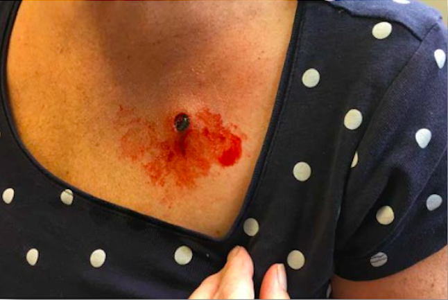 maxpreven's tweet photo. Heridas simuladas en silicona, de entrada y salida de poryectil, para la formacion. #policia #guardiaurbana #policiamunicipal #GuardiaCivil #mossosdesquadra #Ertzaintza #POLICIAMILITARSP https://t.co/sqdmhIbbOl