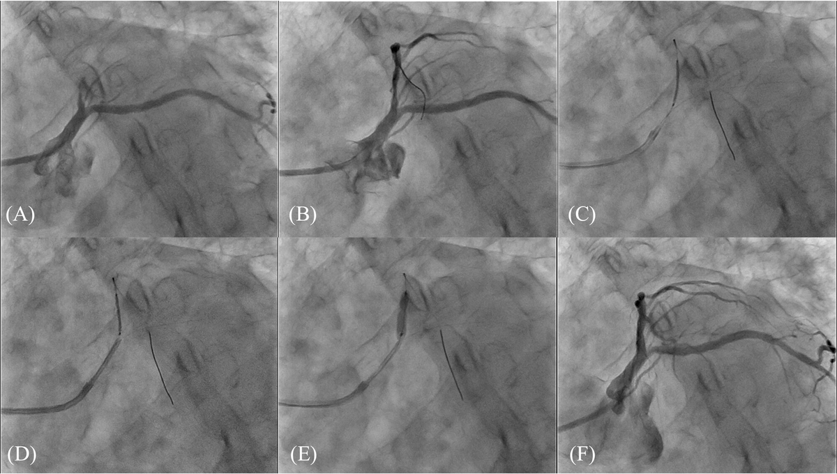 gbiondizoccai's tweet photo. Welcome to the Ostial Stenting With Guide Extension Catheter Tip Technique: a novel approach enabling precise ostial and bifurcation stenting using a guide extension catheter https://t.co/Alfop7WzBQ @ccijournal https://t.co/GYBgqxr7Pw