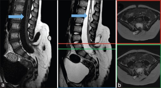 DocNavarrow's tweet photo. 👶3-year-old boy with a lumbar subcutaneous mass detected in infancy. Normal motor development, normal bowel and bladder function, and unremarkable urodynamic studies. Parents report intermittent morning back and leg stiffness. 

🧑‍⚕️What is your diagnosis? https://t.co/2yCPrwmoZ7