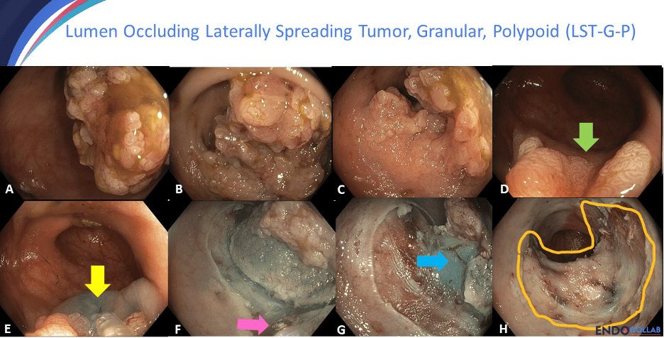 theendoscopist's tweet photo. An elderly patient presented with recurrent hematochezia and anemia.

Read the full case: https://t.co/QgircpiieH https://t.co/5mwNKznIrl