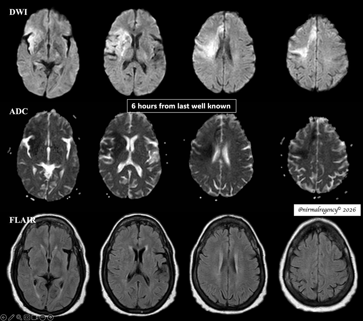 nirmalregency's tweet photo. ❶ | ❽  🧵 #Stroke
Last Known Well at ~2AM talking to her spouse.
At 6AM found to have left hemiparesis.
#MRI was performed at 800AM − 6 hours from LKW.