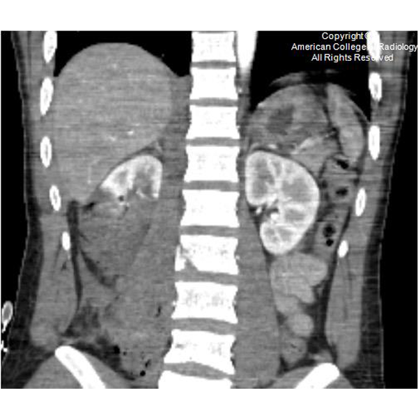 RadiologyACR's tweet photo. A 24-year-old male presents to the ED with multiple gunshot wounds of the back and right upper extremity. #ACRCaseinPoint https://t.co/6XiGB0MUlL https://t.co/uaDPX2oobI