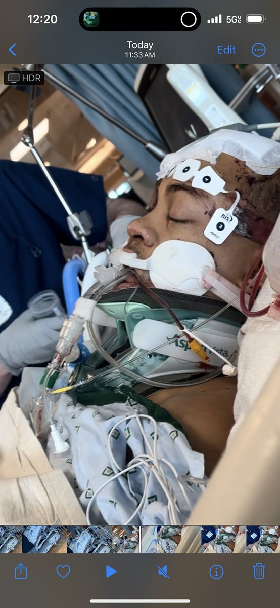ZAEDAE7777's tweet photo. @Jayecane Got into a motorcycle Accident Unfortunately 🤦‍♂️.  broke my leg fractured my skull and displaced my spine Unfortunately.  it was very Traumatizing Doctor's said I was not going to wake up it was over but within 2 days from them saying that I randomly Woke up that's to oure Lord 🙏 https://t.co/YK5k1nvB6I