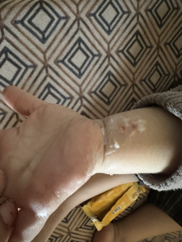 AssanFrom's tweet photo. Scabies has spread all over my child's body I am worried about my baby girl 😥😭😓😥

 Donate even $10
https://t.co/BOrmBCLXGY https://t.co/2bZ06h5eUe