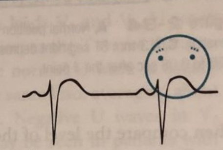 drmalshehri's tweet photo. "Happy Face vs Frowny Face" in ECG

​- A 'Happy Face' usually indicates a benign condition like acute pericarditis, in stark contrast 'Frowny Face' ECG usually indicates an acute injury pattern like MI https://t.co/xFJ2wcZwGY