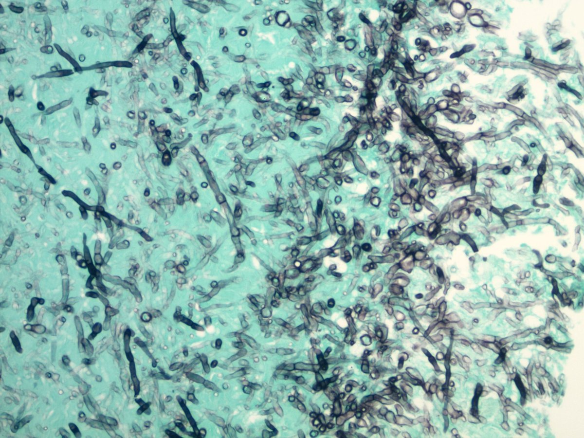 smlungpathguy's tweet photo. Septate fungal hyphae (GMS): in lung pathology, are they always Aspergillus?

Reference: 
https://t.co/KpH4LVFhaw