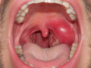 AB_drmd's tweet photo. 🚨🚨🚨حالة خطيرة و مهم تعالجها بحذر: 

المريض عنده حرارة + الم مع البلع. 

⁉️⁉️ايش اول و اهم خطوة تسويها لعلاج الحالة؟؟ https://t.co/NftN4vozza