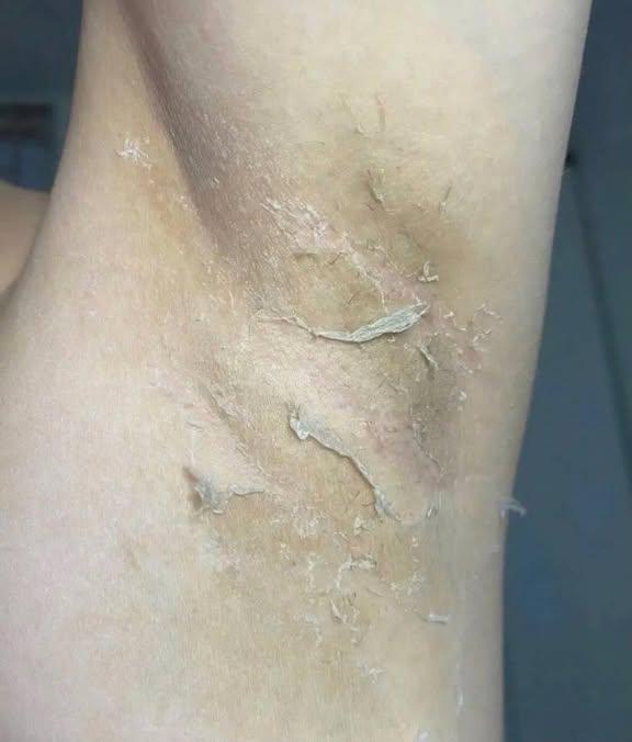 Daniela6071959's tweet photo. Passada que quase ngm sabe que pra ter a axila clarinha você não precisa gastar seu rim, e sim usar um creme clareador que custa menos de 35 reais e clareia tb virilha e até sua alma 🤌🏻 https://t.co/5ExyplCLEq