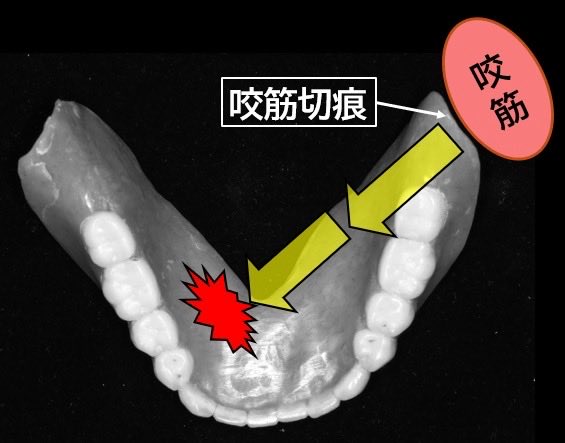 kawazoinoshiro's tweet photo. 主訴の疼痛部位が削合対象ではない例

下全部床義歯(下FD)で下45部粘膜に過接触がある場合,この直上の粘膜面を削合しても疼痛が消退しない場合があります

これは咬筋切痕が不十分の時,咬合時に咬筋が収縮し下FDが反対側の下45部粘膜に間接的に過接触する機序です
対側の咬筋切痕付与が必要となります https://t.co/1lDC0MNNKf