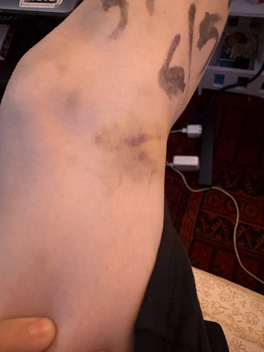 abookofsymbols's tweet photo. it’s hard to demonstrate how banged up i am without this being nsfw but suffice it to say it truly takes brave strong man to shove an unarmed anorexic chick to the ground multiple times !! https://t.co/y5JocQdSyR