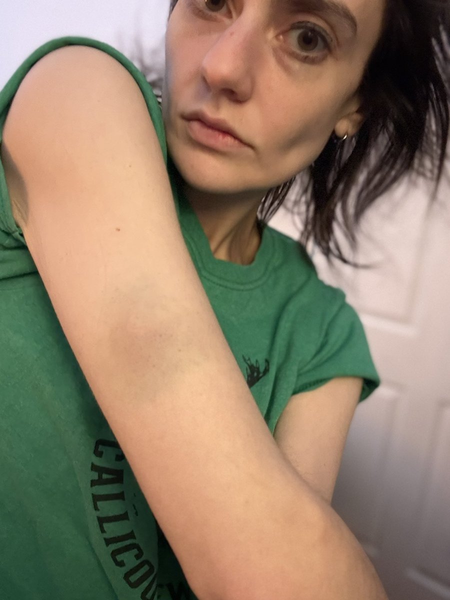 abookofsymbols's tweet photo. it’s hard to demonstrate how banged up i am without this being nsfw but suffice it to say it truly takes brave strong man to shove an unarmed anorexic chick to the ground multiple times !! https://t.co/y5JocQdSyR