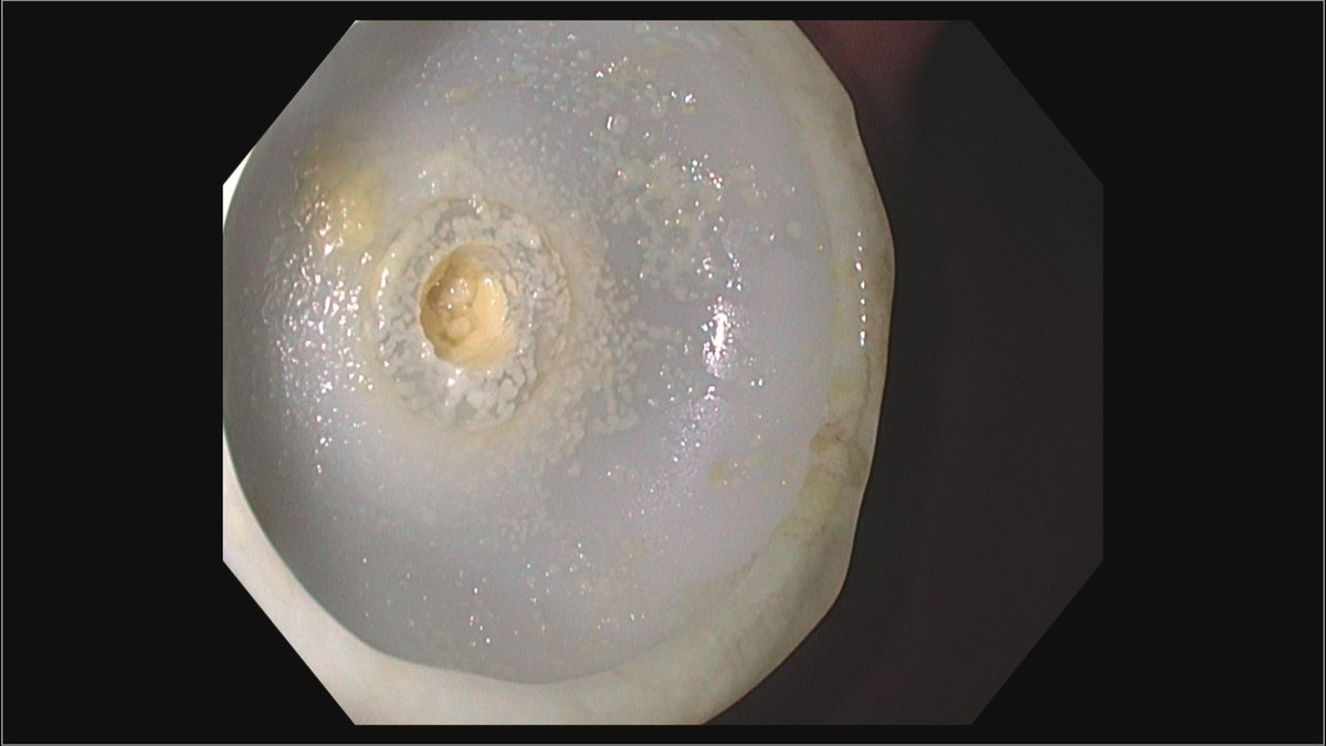 AliRezaieMD's tweet photo. Stubbornly clogged gastrostomy tubes usually don't have a chance vs a scope cleaning brush! 
(22F PEG unclogged with Avanos 5mm brush) https://t.co/unH0jdxnbW
