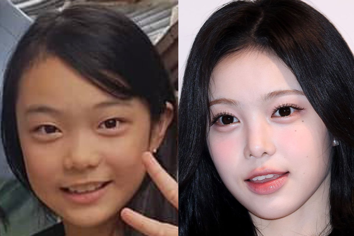 ahyesure's tweet photo. nose implant and double eyelid surgery https://t.co/A02ACHgSVk