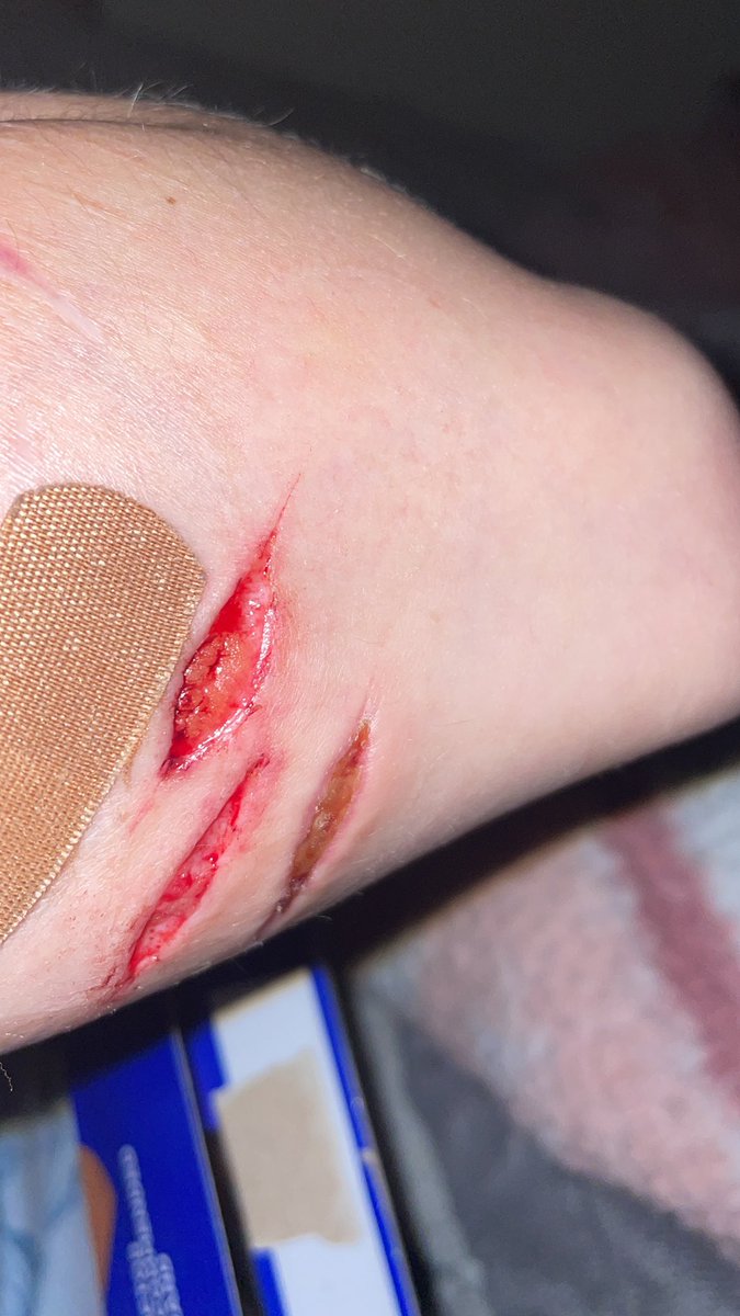 F0reverl1ving's tweet photo. Cut myself when I was drunk yesterday, but Iโm in a lot of pain now which sucks.
#shtwt #beans #styos #fake #notreal https://t.co/MwHKHQlhZF