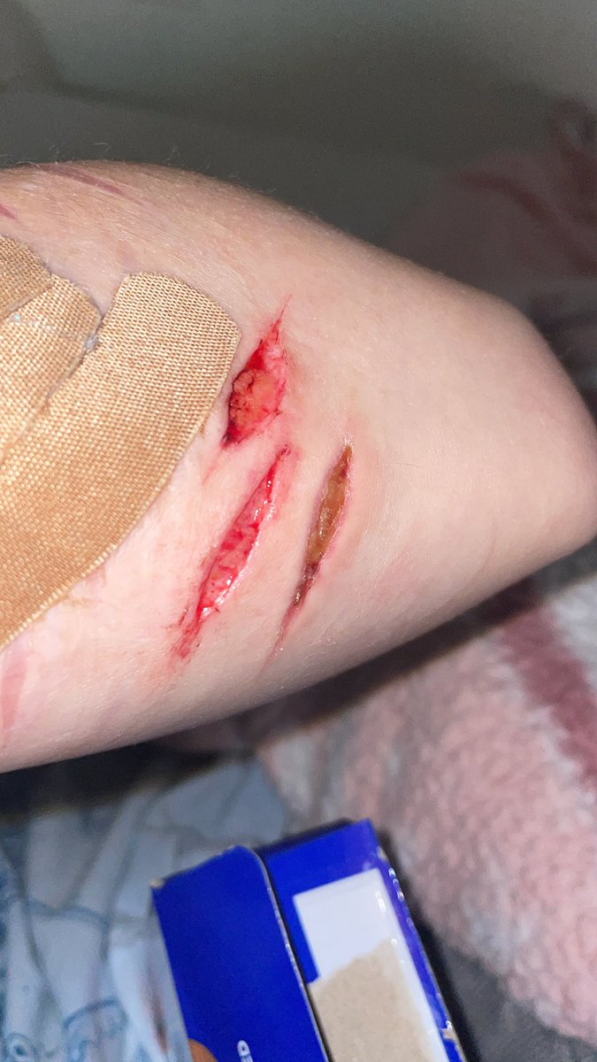 F0reverl1ving's tweet photo. Cut myself when I was drunk yesterday, but Iโm in a lot of pain now which sucks.
#shtwt #beans #styos #fake #notreal https://t.co/MwHKHQlhZF