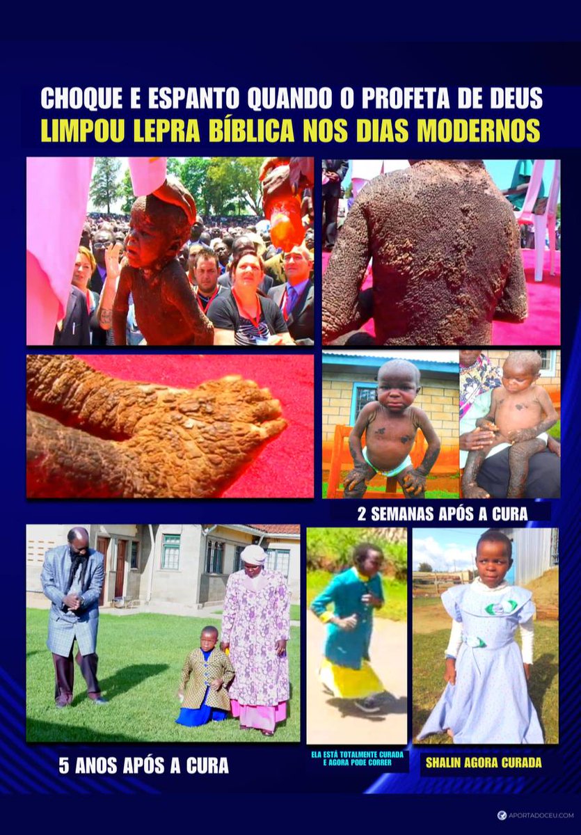 MargareteTabor's tweet photo. @WellenO65288832 Esse milagre bíblico se repetiu nos dias de hoje.
Vejam ela foi curada da lepra. 
#TheHourOfReadiness https://t.co/MKZDVQ9VLK