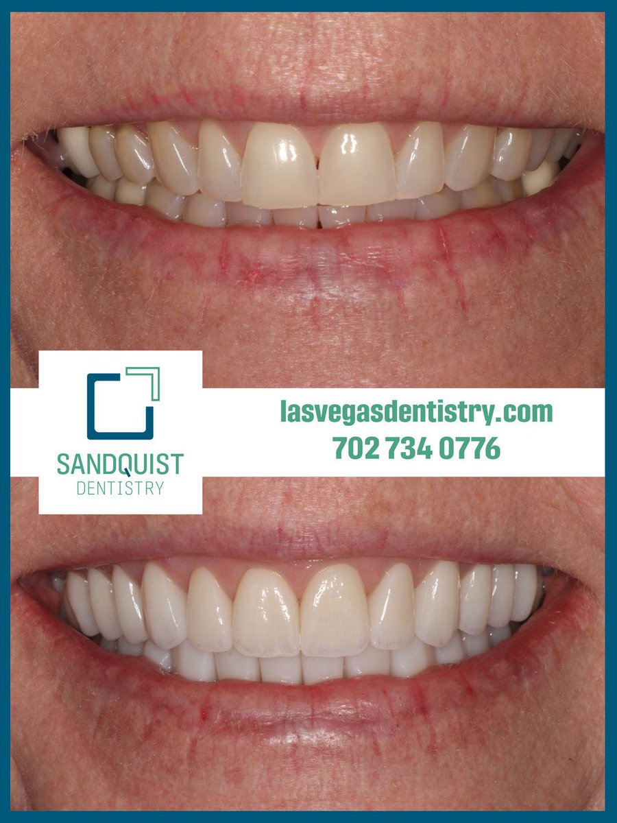 sandquistdds's tweet photo. One of the greatest joys in dentistry is helping someone achieve the smile they’ve always dreamed of having.

Beautiful dentistry isn’t just about straight, white teeth. It’s about creating health, function, stability, and confidence that lasts. https://t.co/dkRe4r8YzB